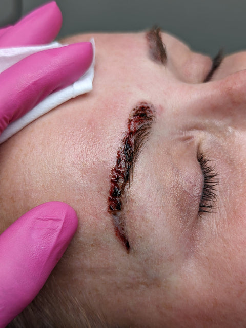 Pigment on the skin's surface after PMU pigment removal with THink Pigment Remover